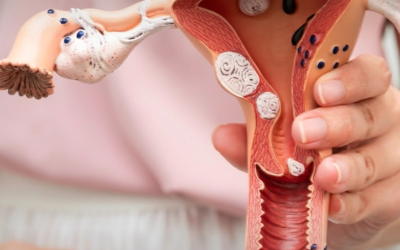 Síndrome de Ovario Poliquístico: Síntomas y Diagnóstico en Guatemala | Medicuidados